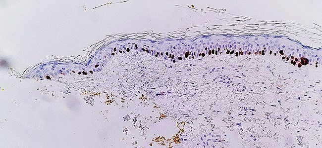 Immunohistochemistry with SOX10 (staining the cell nuclei of melanocytes) facilitates diagnosis of lentigo maligna, in this case showing an increased number of melanocytes along stratum basale of the skin, and nuclear pleumorphism. The changes are continuous with the resection margin (inked in yellow, at left), conferring a diagnosis of a not radically removed lentigo maligna.