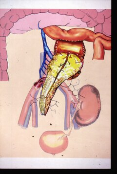 Kidney Pancreas transplantation Schema der Pankreas-Nierentransplantation mit portalvenoser Anastomose des Pankreastransplantats.tif
