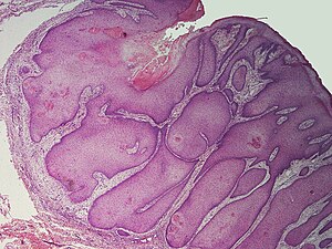 SkinTumors-P8190634.JPG