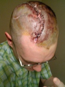 Scar remained from a cranioplasty Stapled-head.jpg