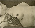 The breast- its anomalies, its diseases, and their treatment (1917) (14756759312).jpg