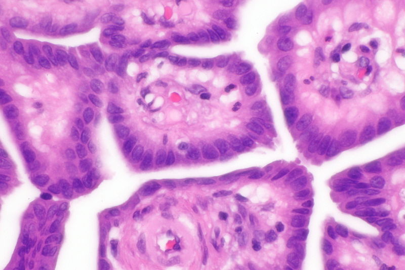 File:Well-differentiated papillary mesothelioma -- very high mag.jpg