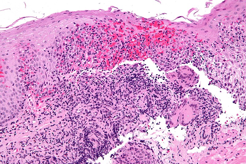 File:Crohn's disease - esophagus - high mag.jpg