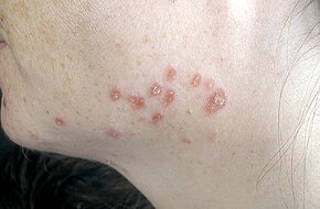 Številne rdečerjave bunčice in lehe na levem predelu spodnje čeljusti pri odraslem bolniku.