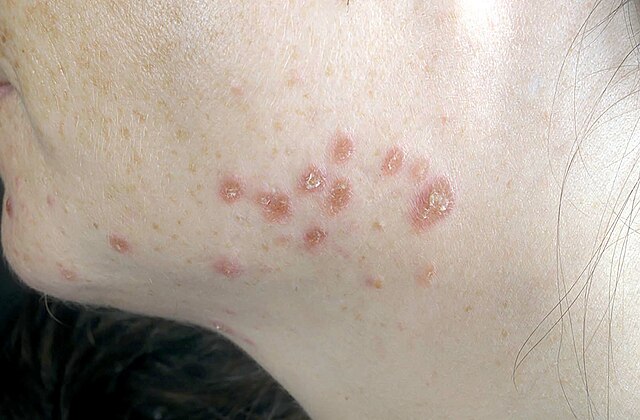 Spot This Rash–Summertime– Sun Sensitivity - Sutton Dermatology +