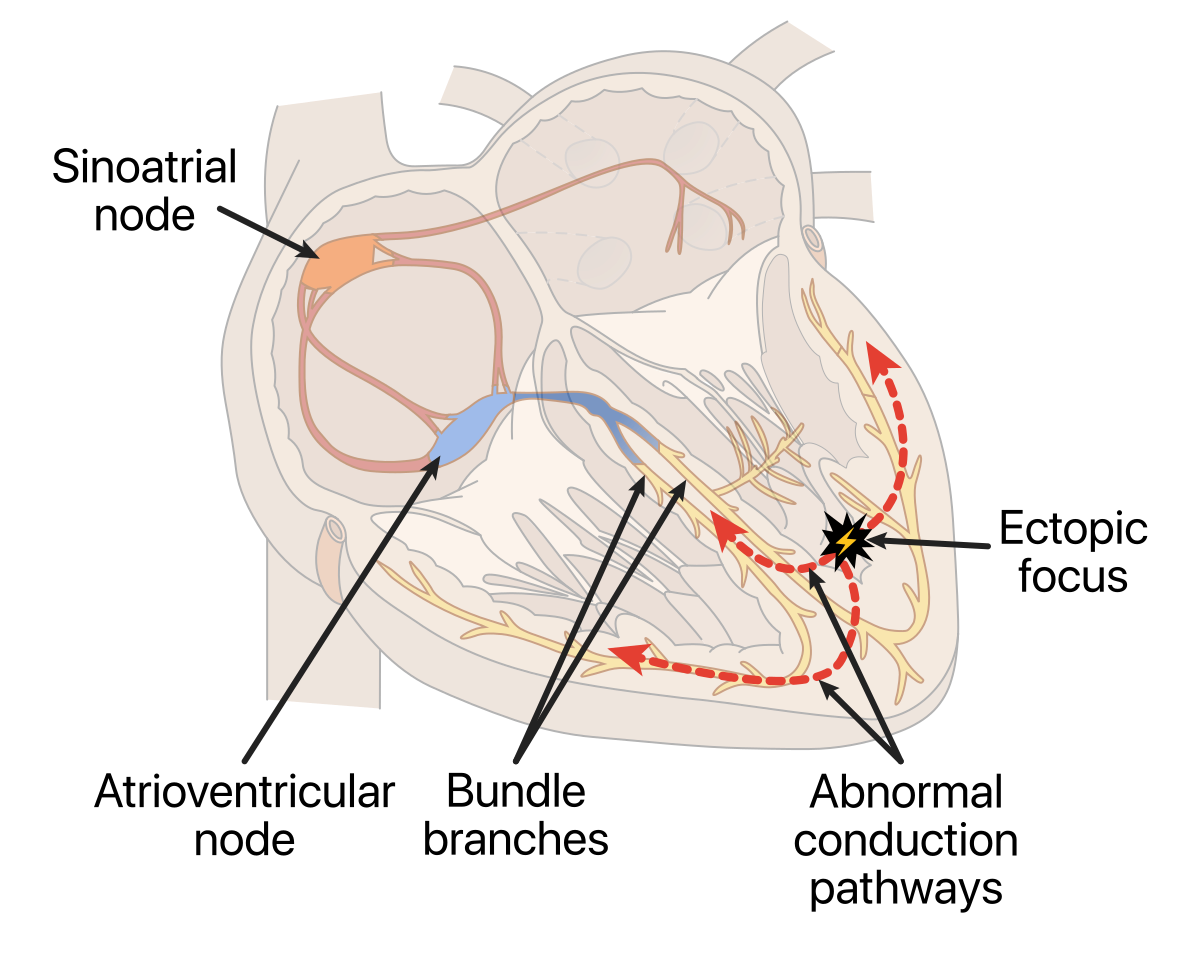 premature ventricular contractions