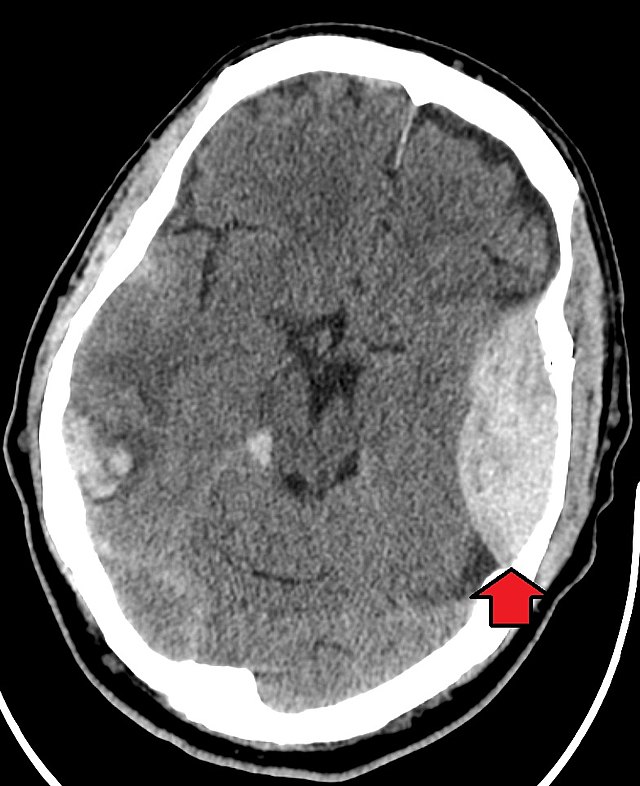 Tension headache: MedlinePlus Medical Encyclopedia