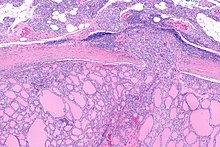 Follicular thyroid carcinoma 2 -- low mag.jpg