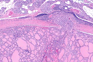 Follicular thyroid carcinoma 2 -- low mag.jpg