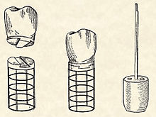 Greenfield's basket: one of the earliest examples of a successful endosseous implant was Greenfield's 1913 implant system Greenfield implant.jpg