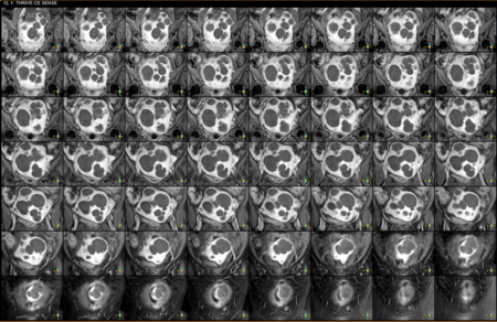 Tập_tin:MRI_HIFU_30_khối_u_xơ_tử_cung.png