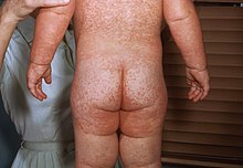 A child with measles showing the characteristic red blotchy rash on his buttocks and back during the 3rd day of the rash Measles rash PHIL 4497 lores.jpg