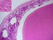 Meningitis Histopathology