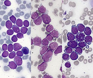 <span class="mw-page-title-main">Acute lymphoblastic leukemia</span> Blood cancer characterised by overproduction of lymphoblasts