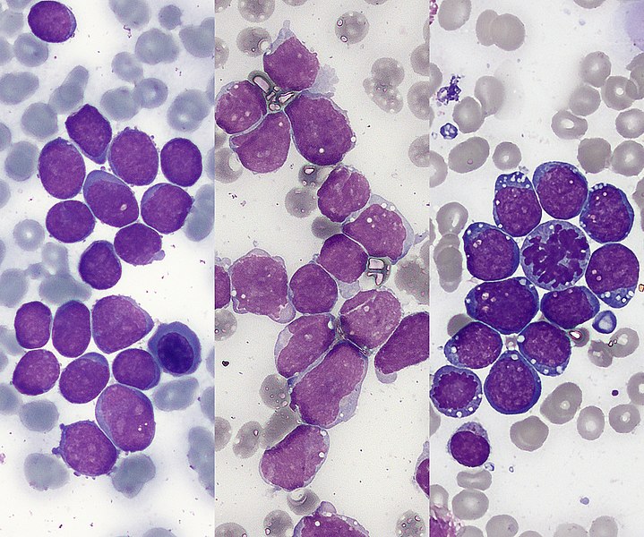 File:Morphological types of acute lymphoblastic leukemia.jpg