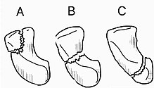 Scaphoid fractures occur in three locations: (A) Distal tubercle, (B) waist, and (C) proximal pole. Scaphoid.jpg