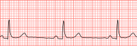 Bradicardia sinusale: si ha con l'abbassamento della frequenza cardiaca al di sotto di 60 battiti al minuto