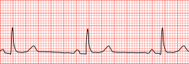 Sinusbradycardie op ECG