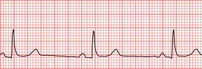 Sinus bradycardia lead2.svg