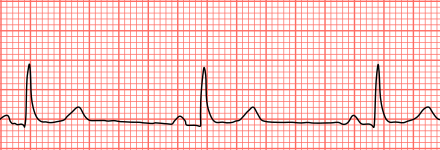 Sinus Bradycardia Wikiwand