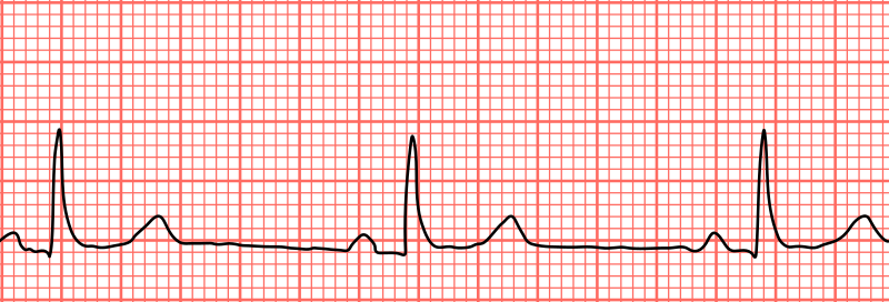 Slow Heart Rate: What You Need to Know: Premier Cardiology