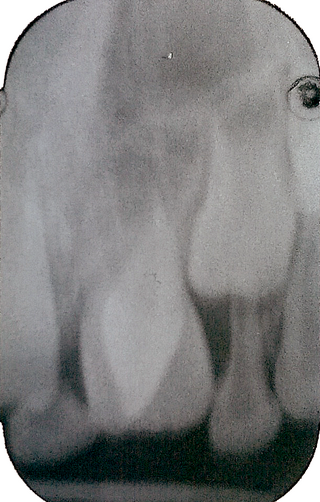 <span class="mw-page-title-main">Talon cusp</span> Rare dental anomaly resulting in teeth having more than one cusp