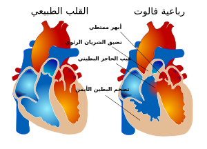 Tetralogy of Fallot Arabic.svg