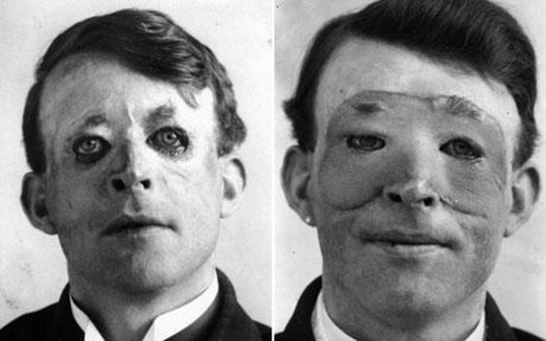 Walter Yeo, a sailor injured at the Battle of Jutland, is assumed to be the first person to receive plastic surgery in 1917. The photograph shows him 