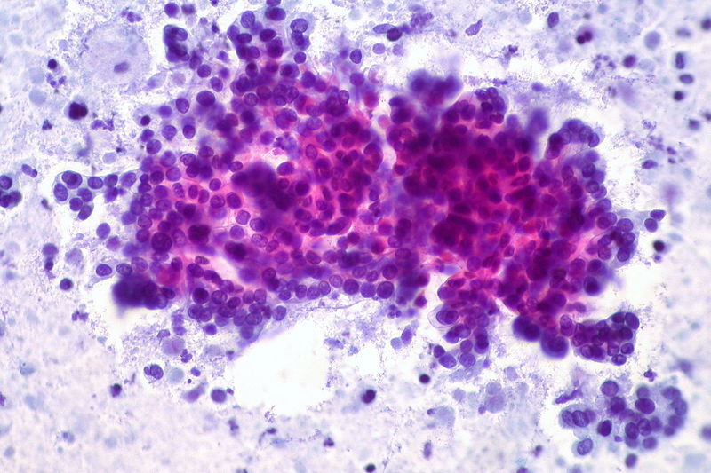 File:Adenocarcinoma of Pancreas, FNA (5558642382).jpg