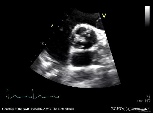 File Bicuspid Aortic Valve Severe Aortic Regurgitation