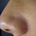 Sebaceous filaments are commonly mistaken for blackheads. However, they are completely harmless and are a natural part of the skin for people with oily skin.[5]