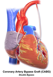 Double coronary artery bypass.