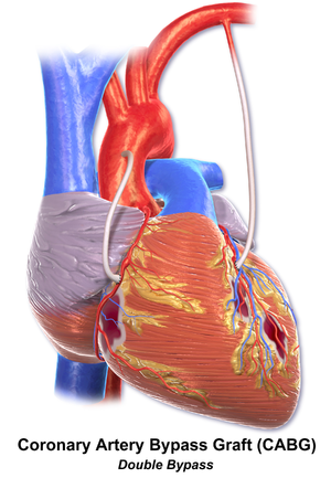 Blausen 0153 CABG Double.png