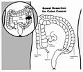 Thumbnail for Bowel resection