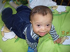 Roční chlapec s Downovým syndromem