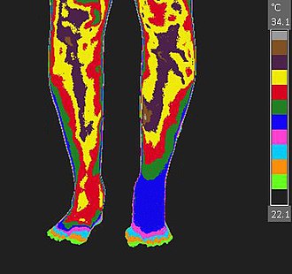 CRPS-RSD of the left foot imaged with medical thermology during a cold pressor test. CRPS-RSD of the left foot.jpg