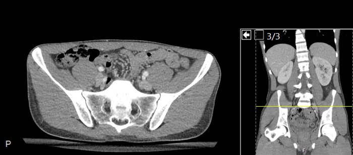 CT of a normal abdomen and pelvis, axial plane 196.png