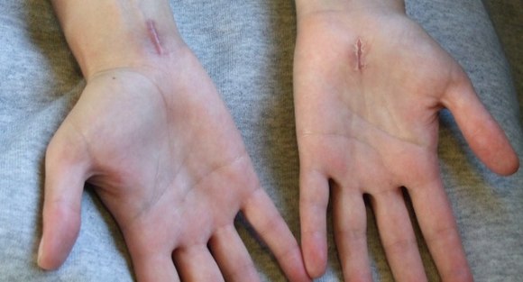 Scars from carpal tunnel release surgery. Two different techniques were used. The left scar is 6 weeks old, the right scar is 2 weeks old.