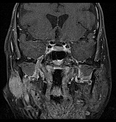 Coronal MRI showing right parotid adenoid cystic carcinoma. Coronal MRI showing right parotid adenoid cystic carcinoma with perineural spread of tumor.jpg
