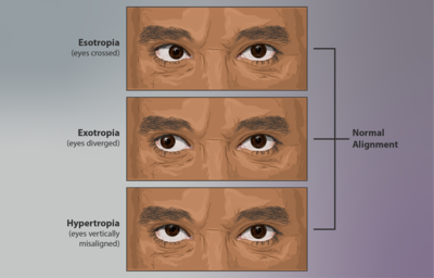 Strabismus is a condition where the eyes are not aligned correctly, also known as "crossed-eyes." It is a common facial symptom of SCARF.[7]