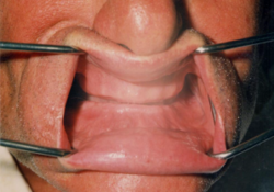 Extra-oral photograph showing a completely edentulous maxillary and mandibular arch Edentulism.png