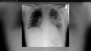Файл: En.Wikipedia -VideoWiki-Cystic fibrosis.webm 