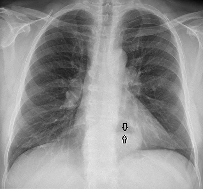 This hiatal hernia is mainly identified by an air-fluid level (labelled with arrows)