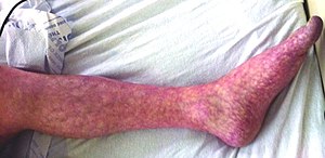 Livedo reticularis of left leg.jpg