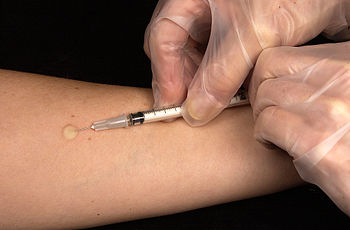 Mantoux tuberculosis test