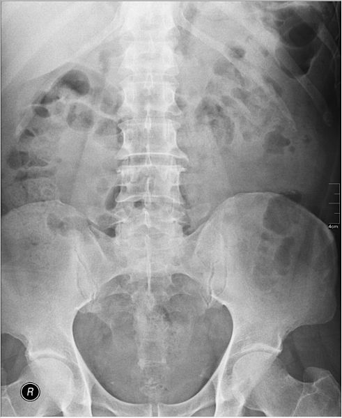 File:Medical X-Ray imaging DFT03 nevit.jpg