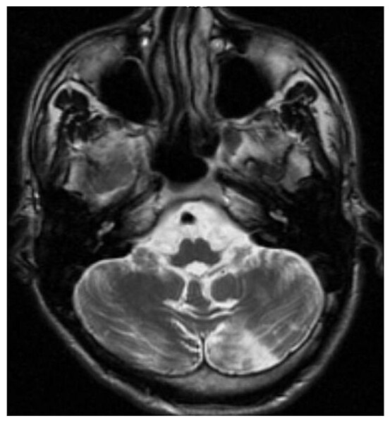 File:Morbus Fabry Stroke 01.jpg