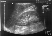 Ultrasound scan of a kidney (right side) MorisonNoText.png