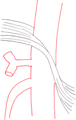 Normal median arcuate ligament and celiac artery.png