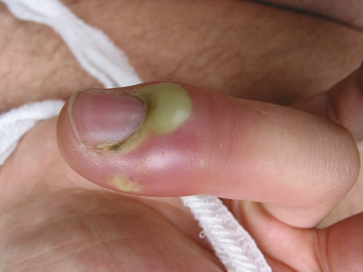 Нарывает палец возле ногтя: лечение паронхии